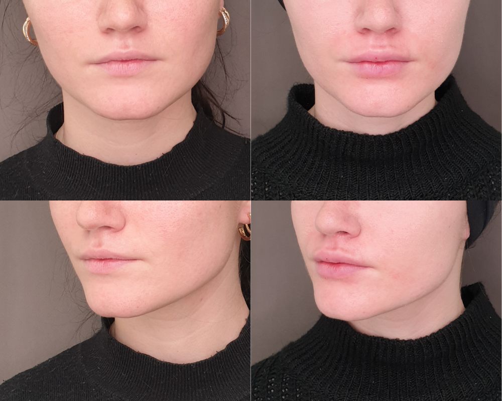 injection acide hyaluronique montpellier