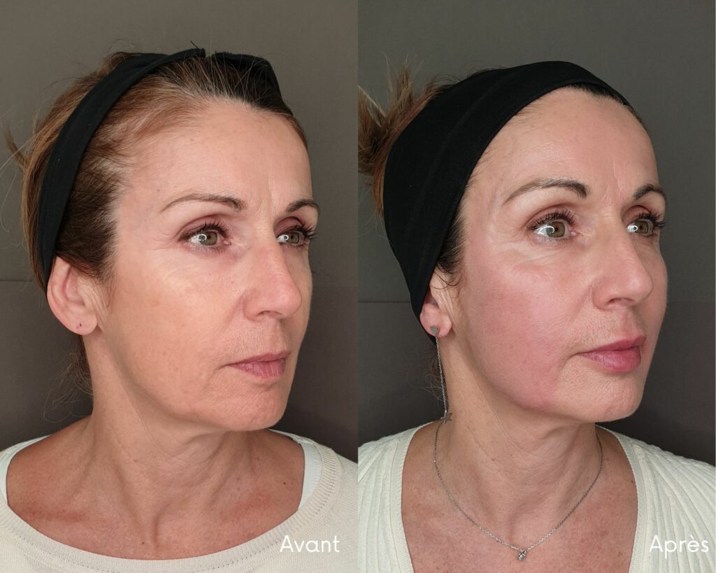 lifting médical montpellier