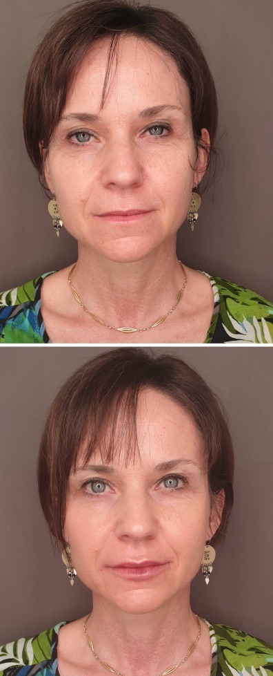 lifting medical montpellier