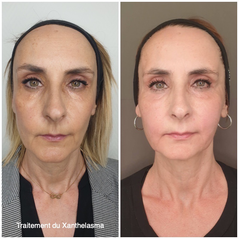 plasma therapie montpellier