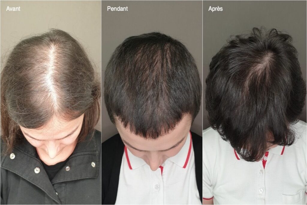 mesogreffe cabinet esthetique montpellier