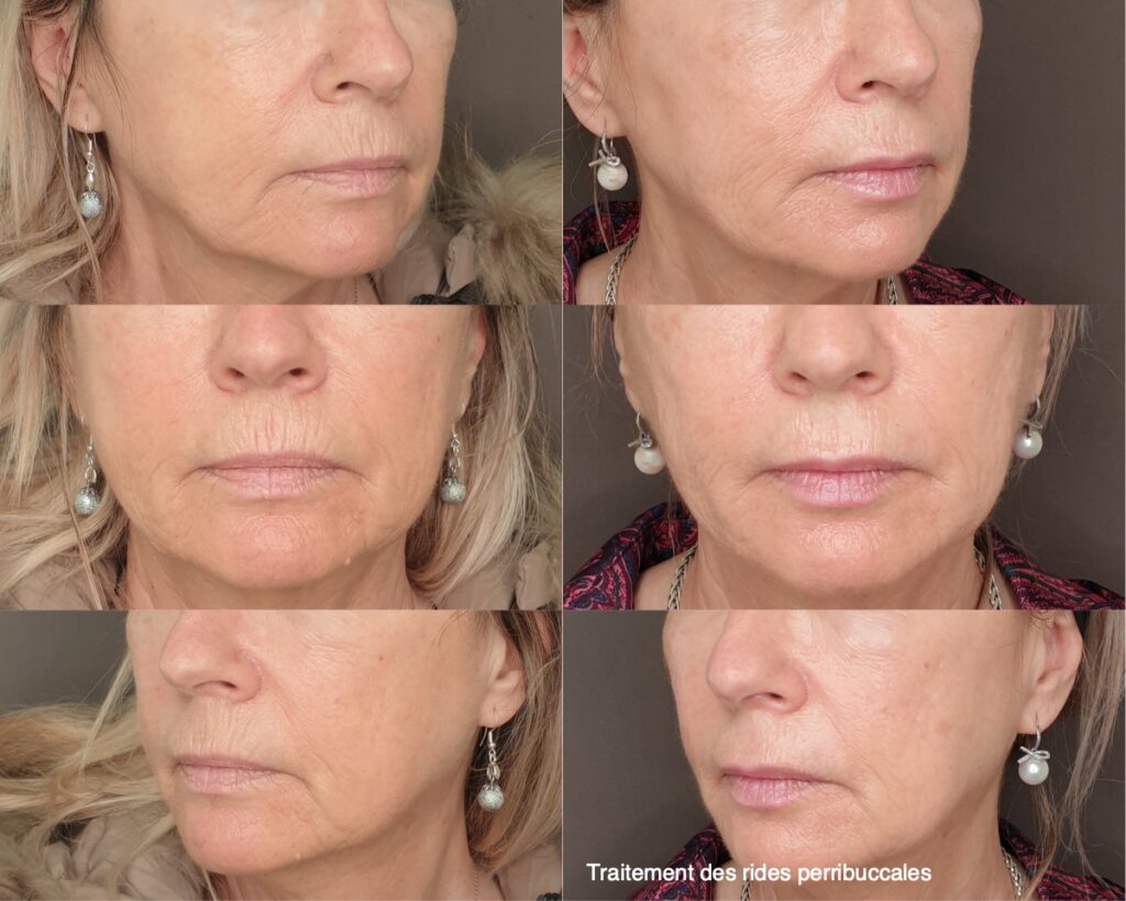 plasma therapie centre esthetique montpellier