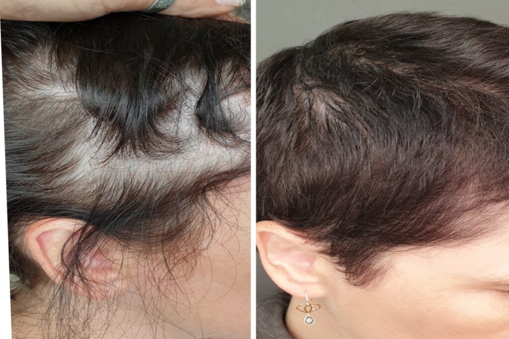 mesotherapie montpellier