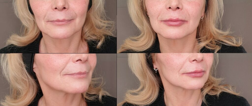 injection acide hyaluronique bouche montpellier