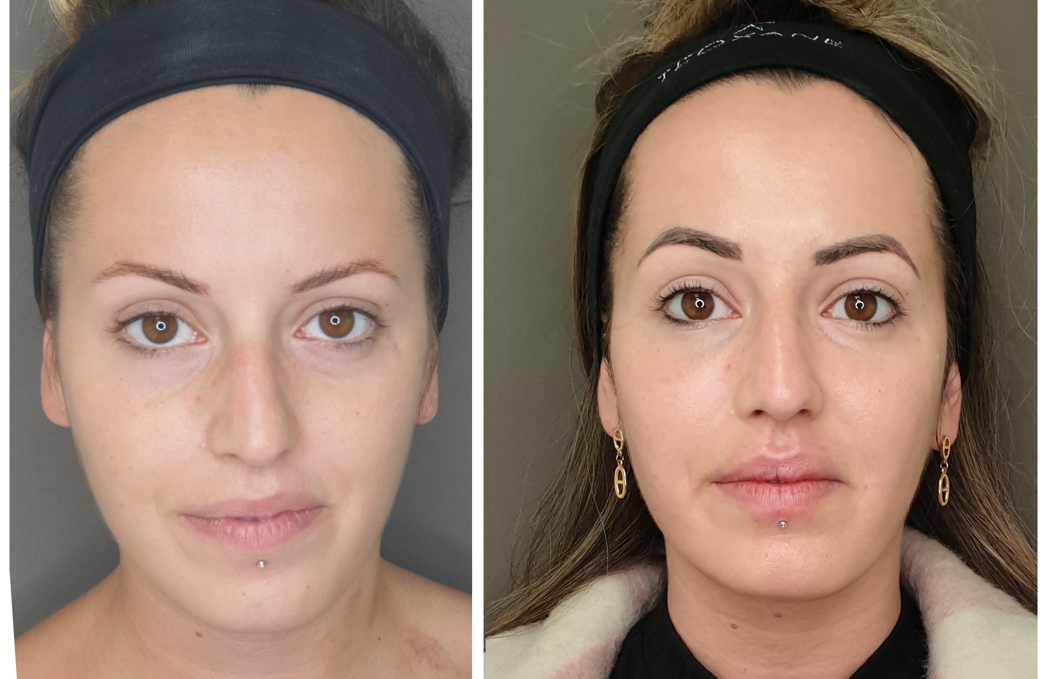 traitement des cernes montpellier