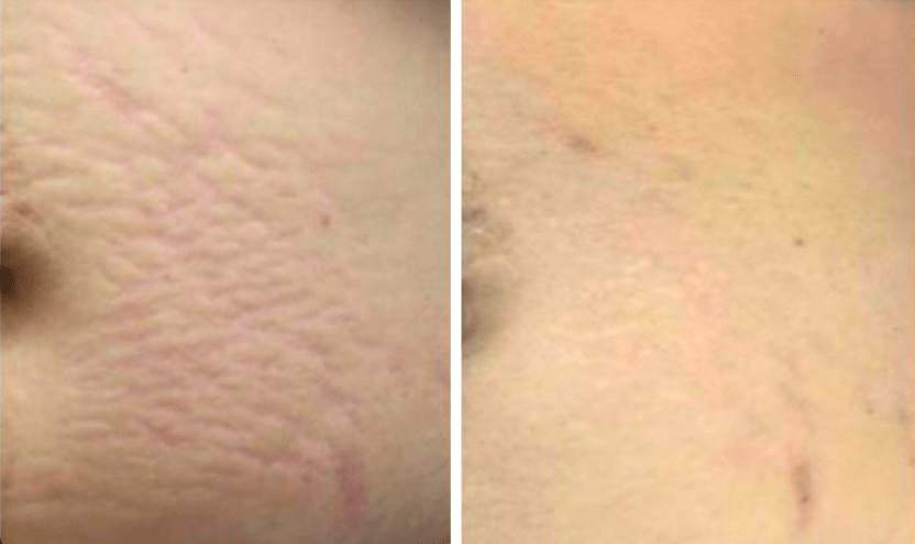 Vergetures Avant Après