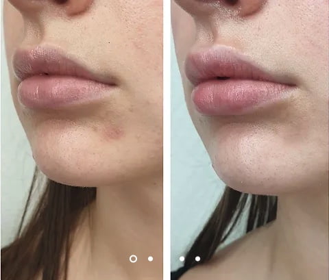 Botox lèvres · résultat · Dr Marianne Cayatte Montpellier