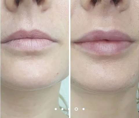 Botox lèvres · lip flip · Dr Marianne Cayatte Montpellier
