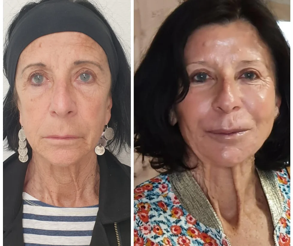 Botox visage · avant / après · Dr Marianne Cayatte Montpellier