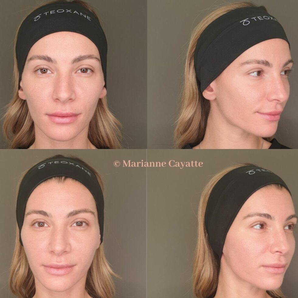 Microneedling avant après · texture peau cicatrices · Dr Marianne Cayatte Montpellier
