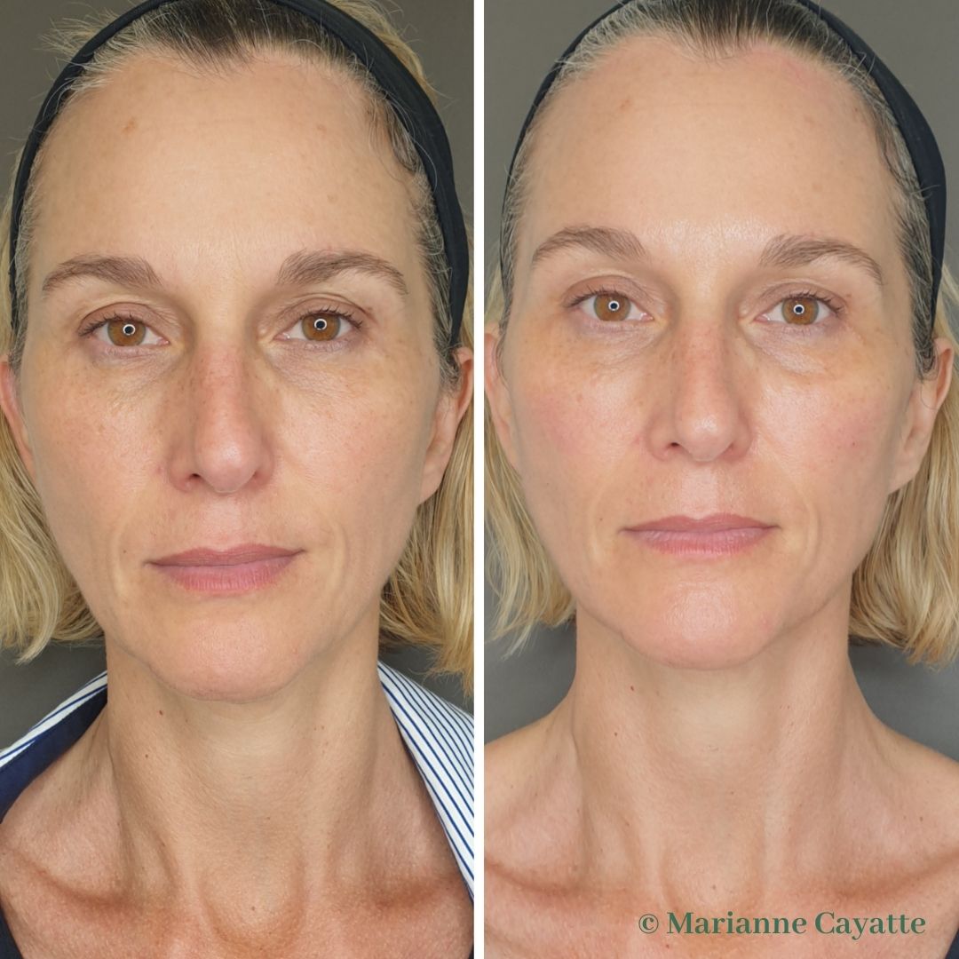 Microneedling teint unifié pores resserrés avant après · Dr Marianne Cayatte Montpellier