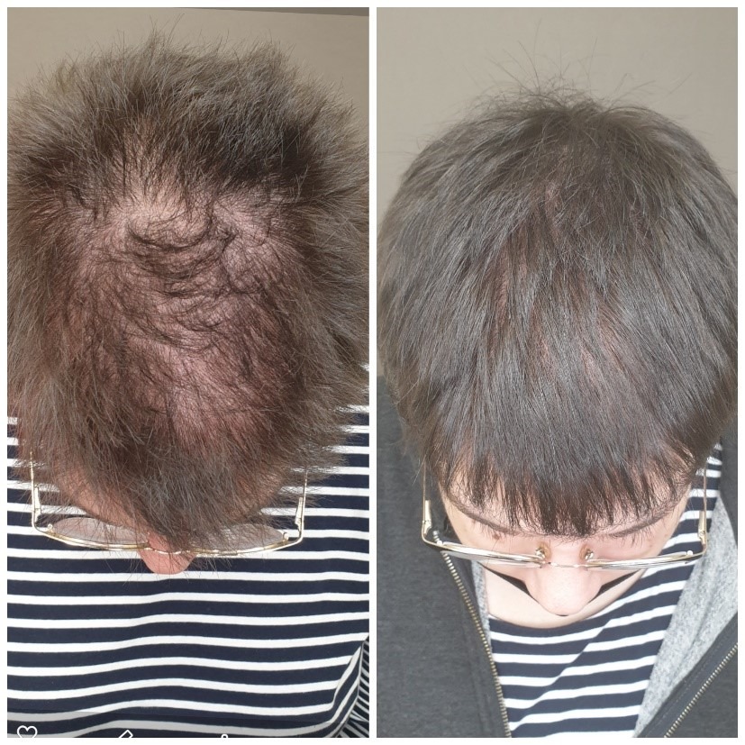 Mésothérapie capillaire 6 mois · résultat 2 · Dr Marianne Cayatte Montpellier