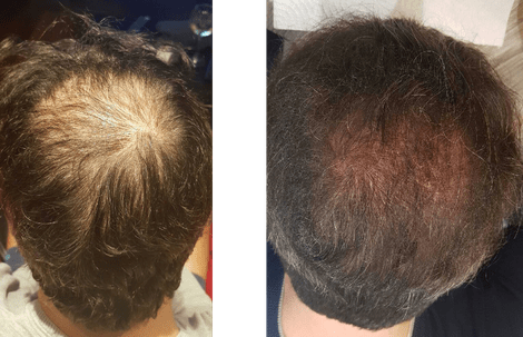 Mésogreffe homme · densité · Dr Marianne Cayatte Montpellier
