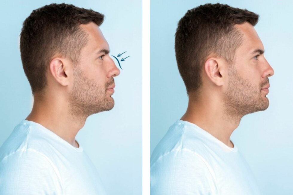 Rhinoplastie médicale avant après homme — correction bosse nasale acide hyaluronique · Dr Cayatte Montpellier