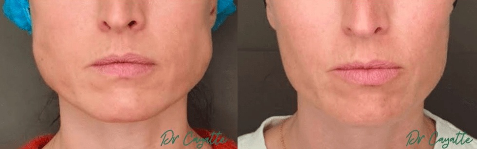 Botox masséters bruxisme avant après · Dr Marianne Cayatte Montpellier