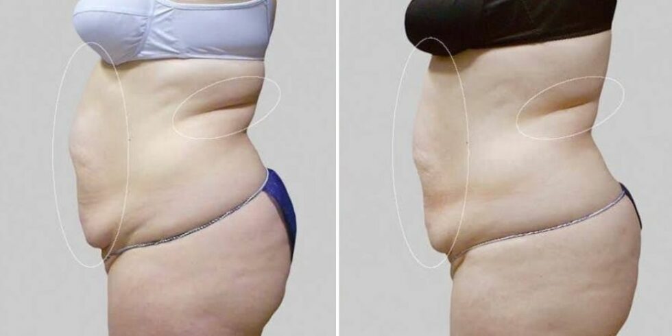 Cryolipolyse Lipocontrast avant après résultat · Dr Marianne Cayatte Montpellier