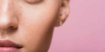 Injection acide hyaluronique joues volumes Montpellier · Dr Marianne Cayatte