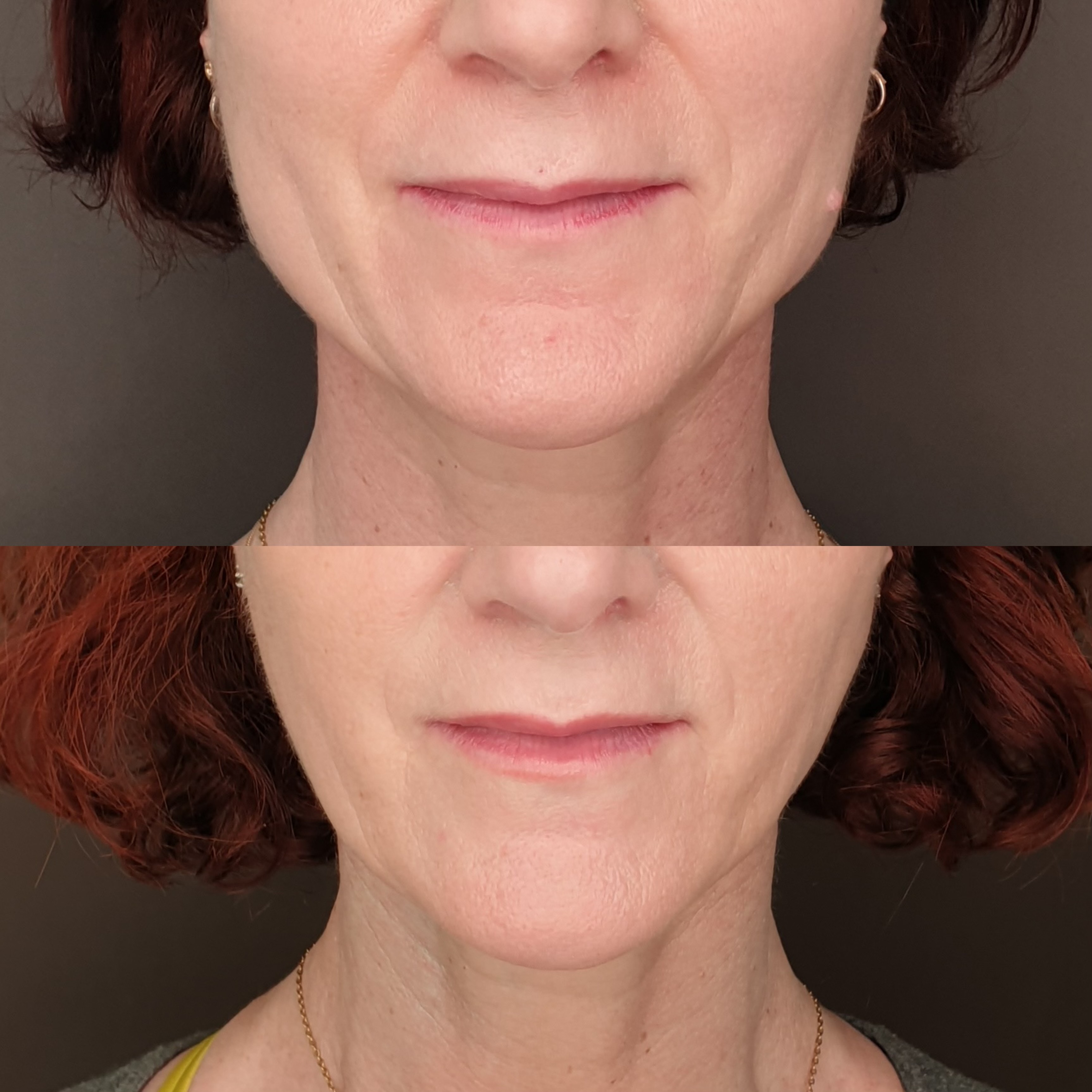 Masséters affinement ovale botox bruxisme avant après · Dr Marianne Cayatte Montpellier