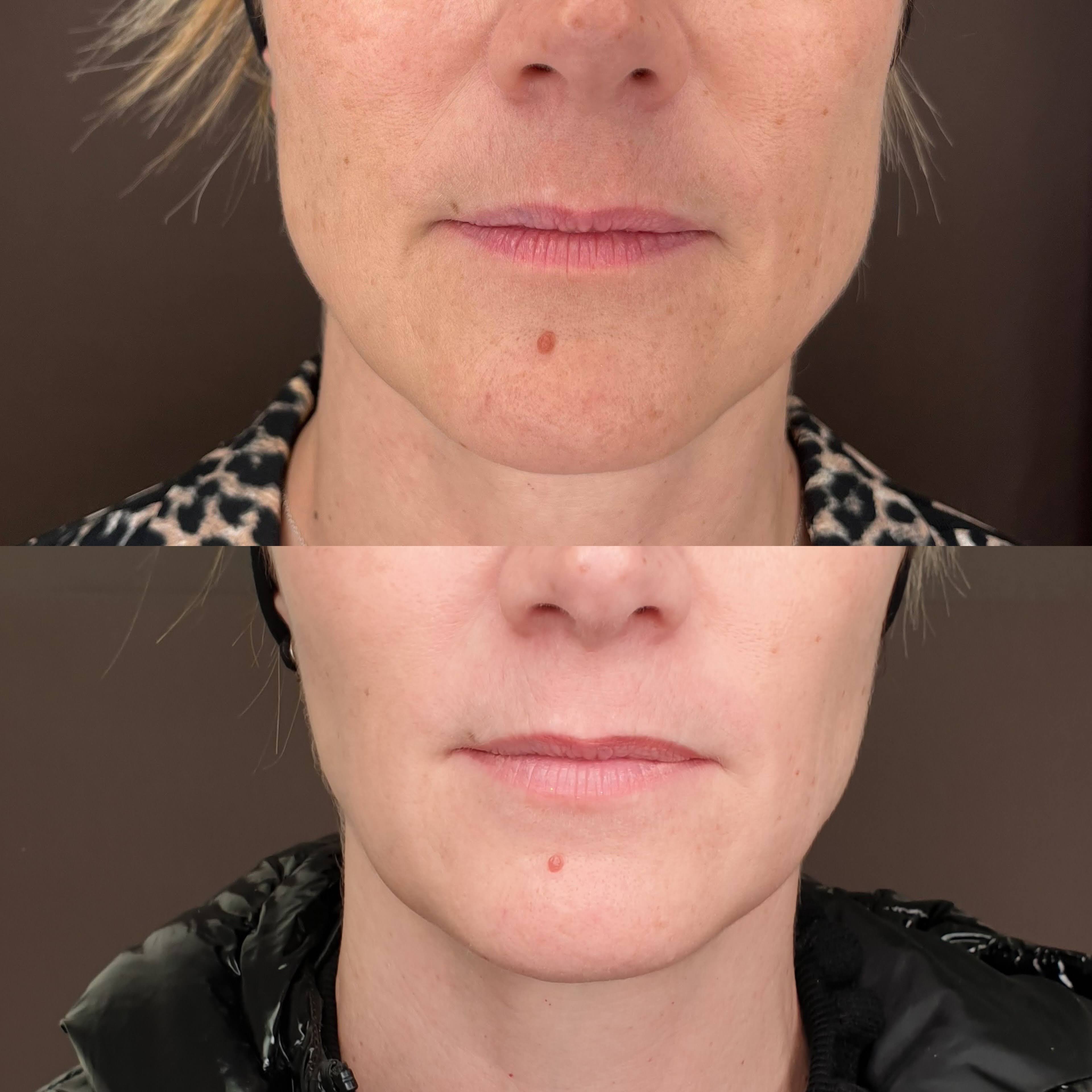 Bruxisme · résultat botox · Dr Marianne Cayatte Montpellier