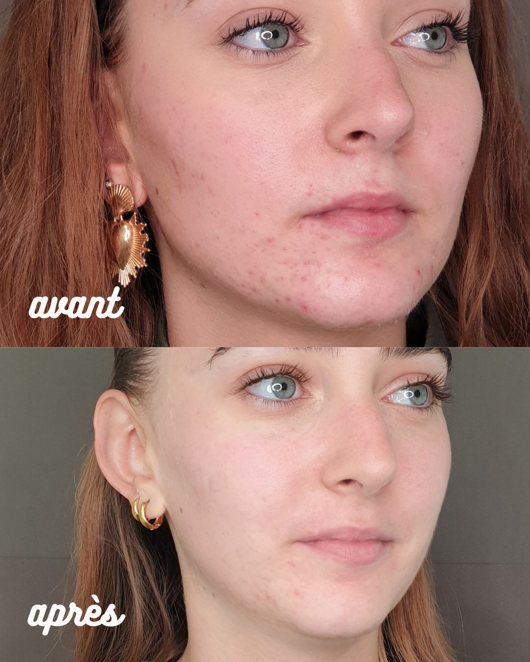 Microneedling résultat global visage avant après · Dr Marianne Cayatte Montpellier