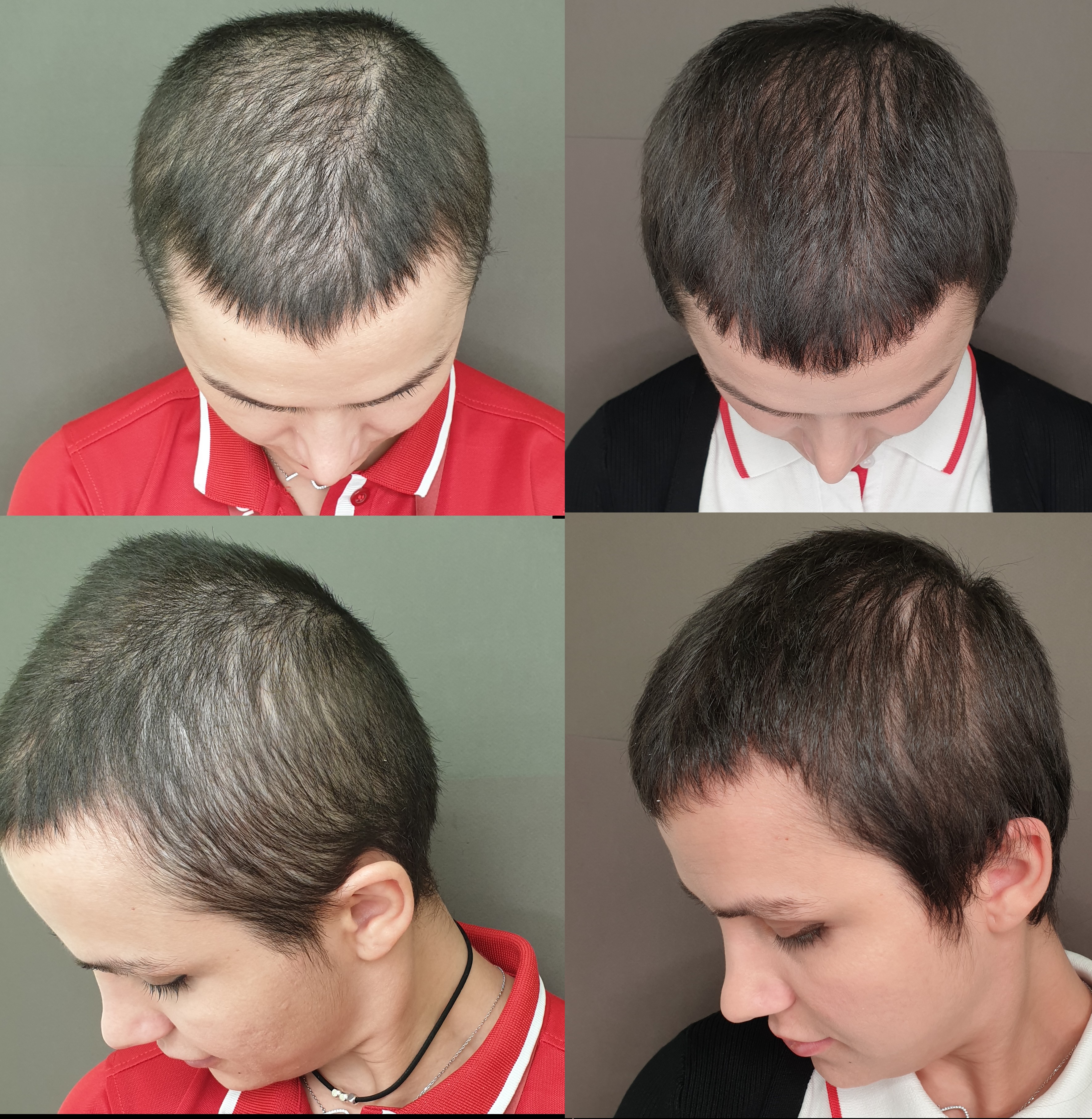 PRP cheveux repousse densification avant après · Dr Marianne Cayatte Montpellier