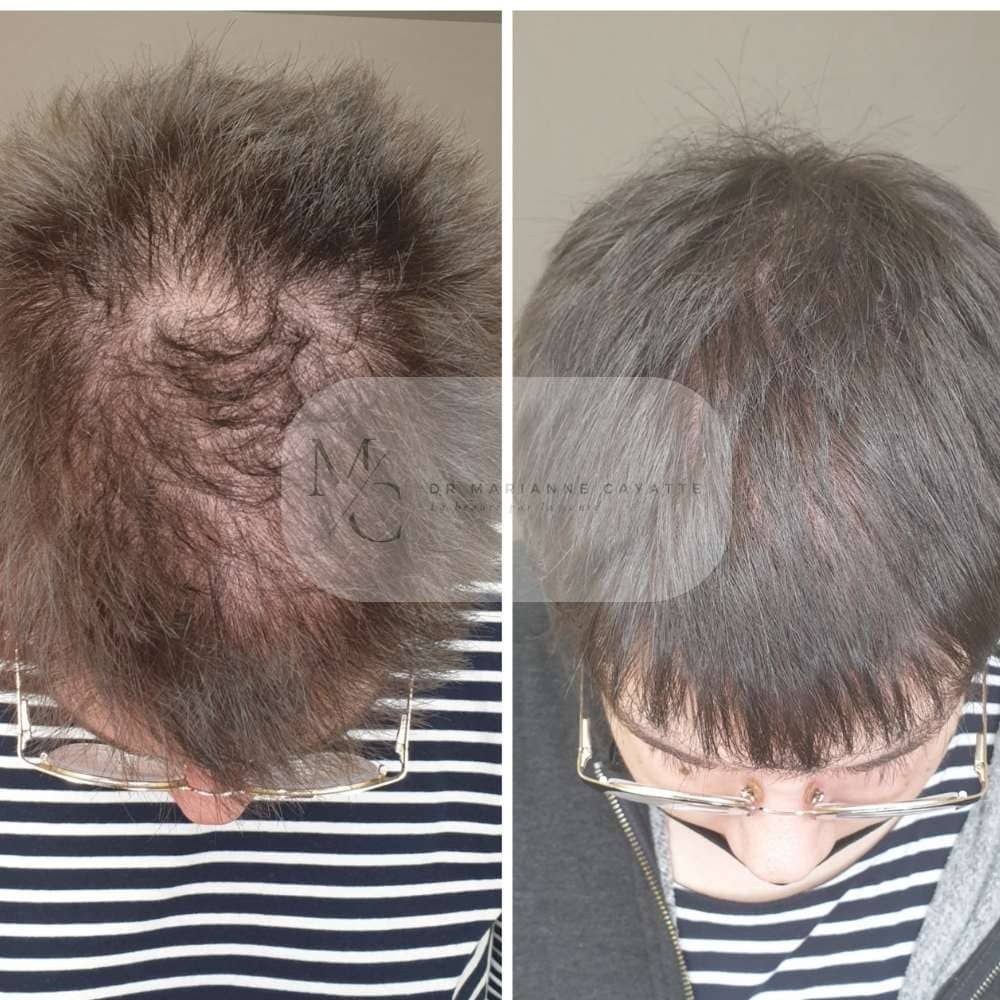 Mésothérapie capillaire chute cheveux · Dr Marianne Cayatte · Montpellier