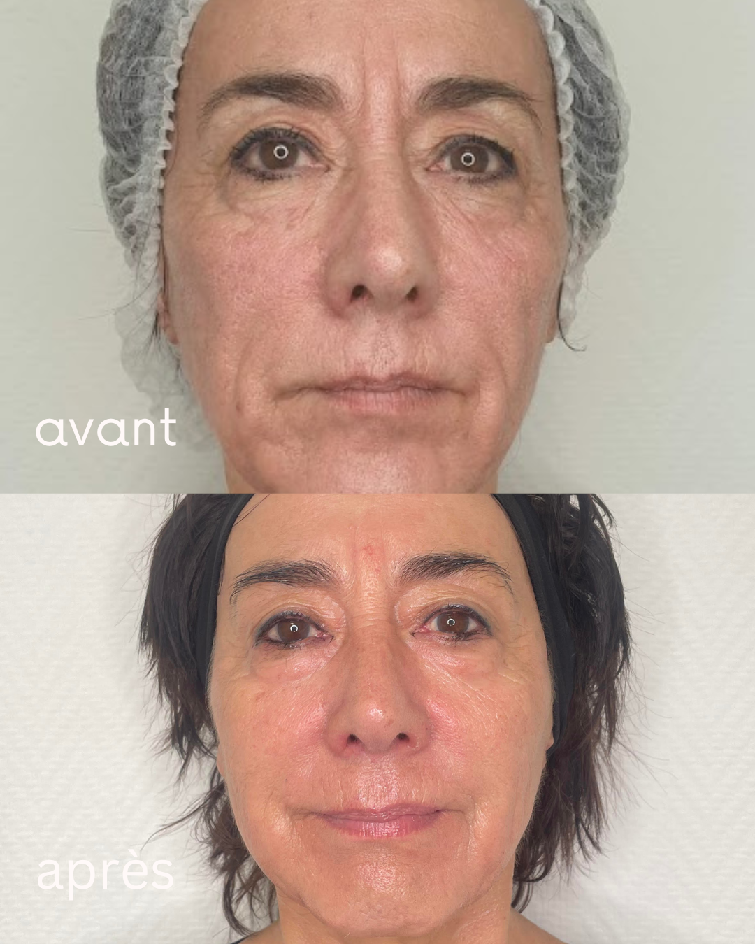 Microneedling Hydrafacial combiné avant après · Dr Marianne Cayatte Montpellier