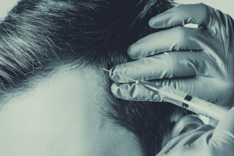 PRP cheveux traitement alopécie Montpellier