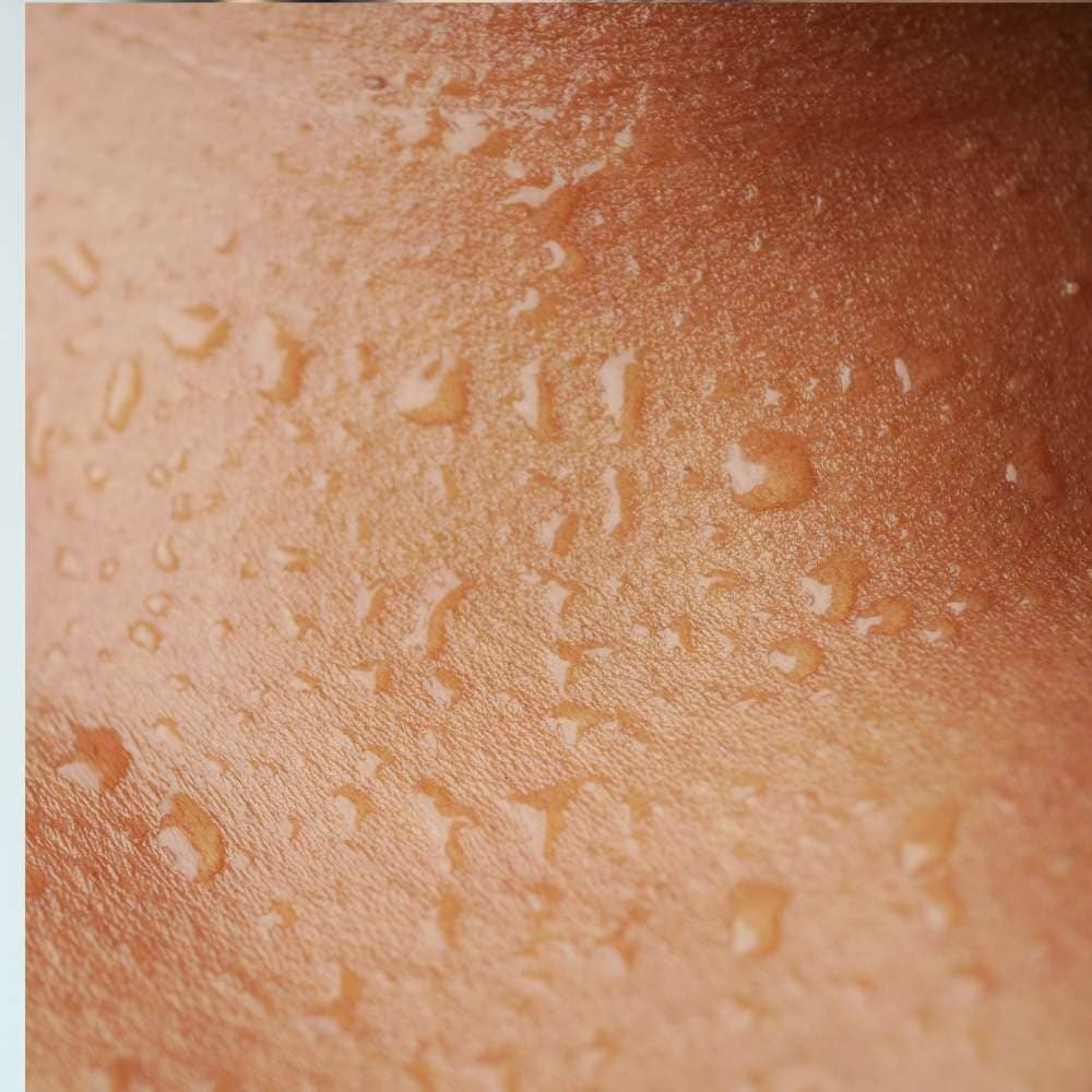 Traitement transpiration hyperhidrose Botox · Dr Marianne Cayatte · Montpellier