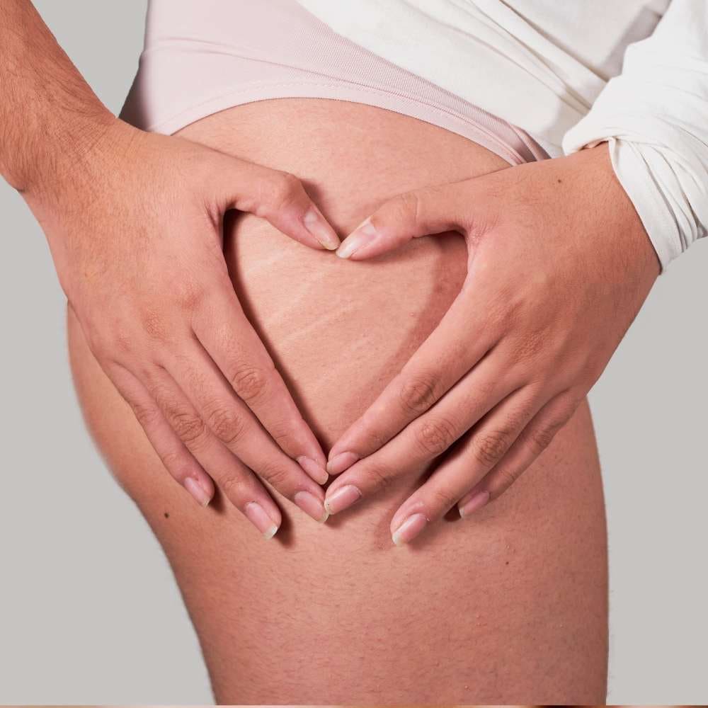 Microneedling traitement vergetures · Dr Marianne Cayatte · Montpellier