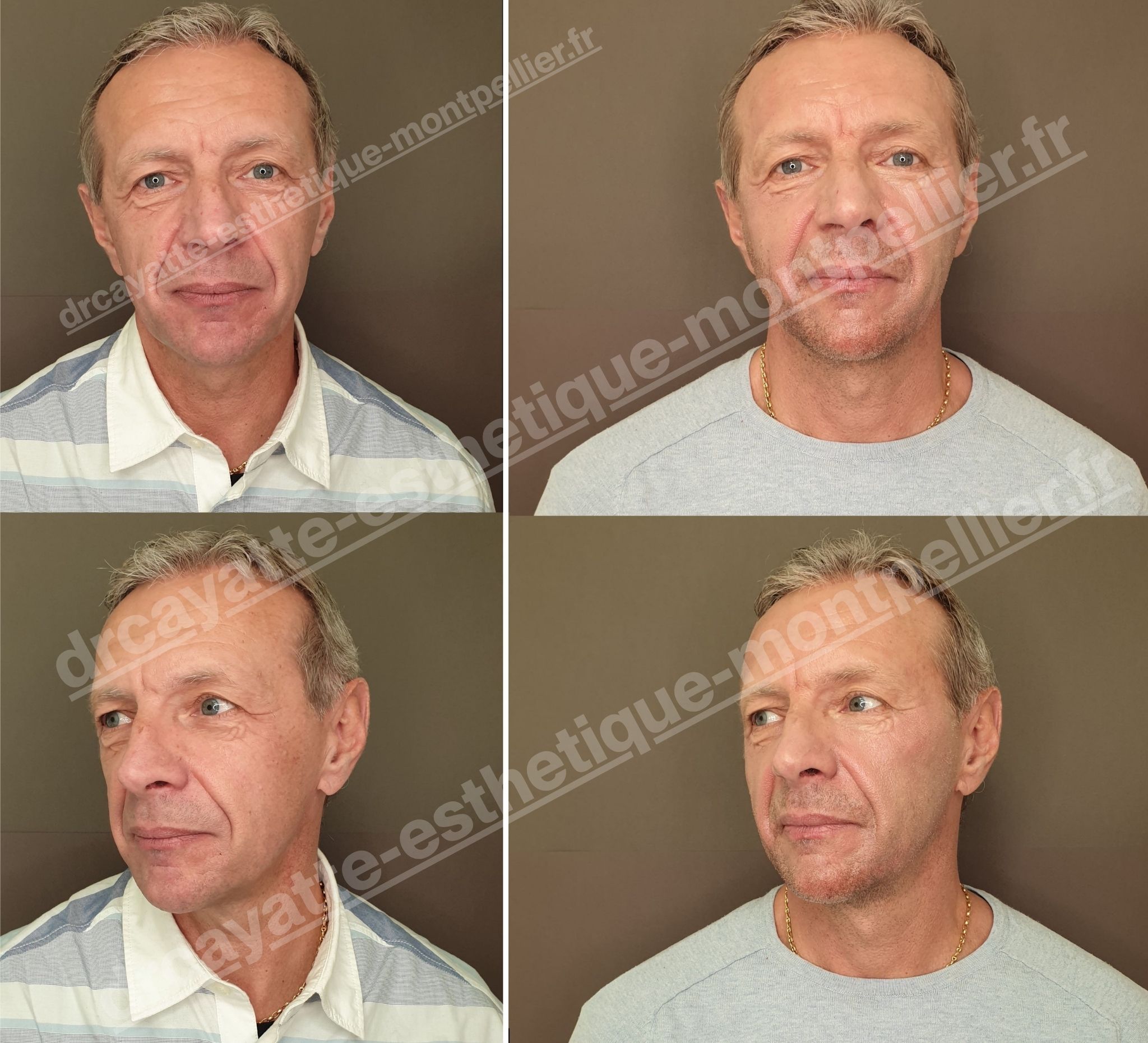 Injection acide hyaluronique homme avant après résultat · Dr Marianne Cayatte Montpellier