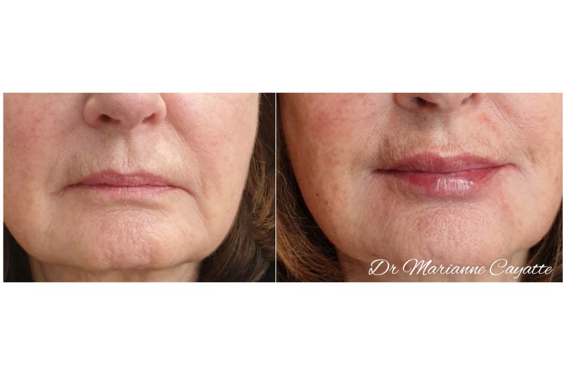 Remonter les commissures · injection acide hyaluronique lèvres · Dr Marianne Cayatte Montpellier