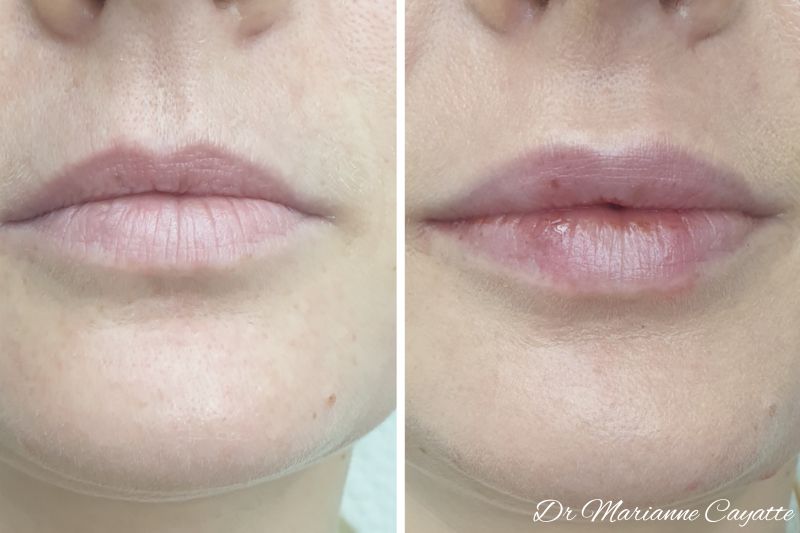 Corriger une asymétrie des lèvres · injection acide hyaluronique · Dr Marianne Cayatte Montpellier