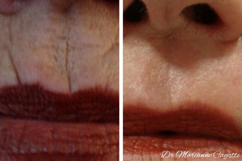 Estomper le code-barre · injection acide hyaluronique lèvres · Dr Marianne Cayatte Montpellier