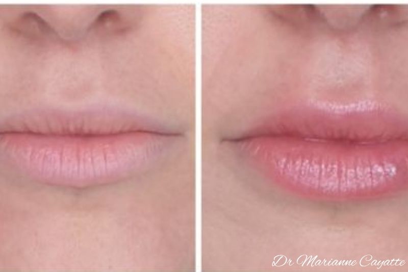 Redessiner l'arc de Cupidon · injection acide hyaluronique lèvres · Dr Marianne Cayatte Montpellier