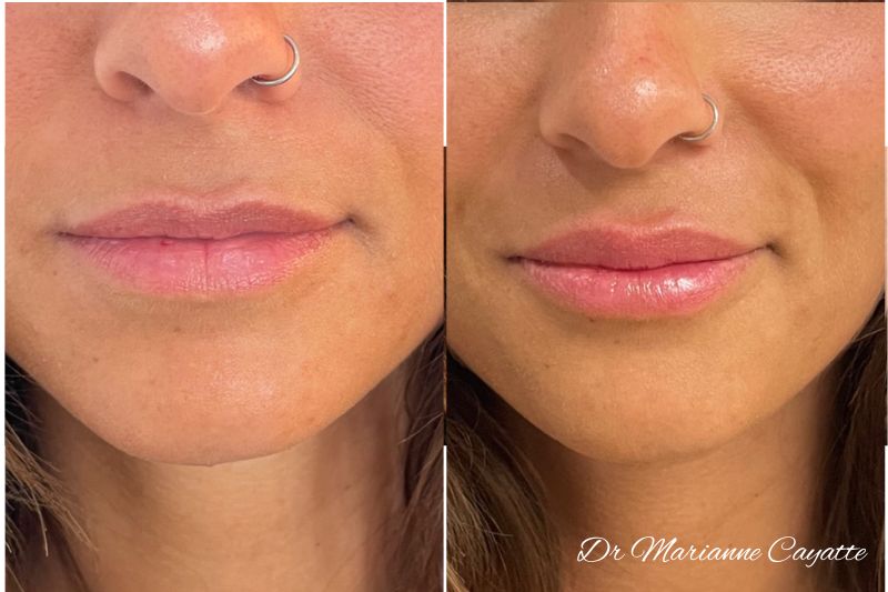 Repulper la lèvre rouge · injection acide hyaluronique lèvres · Dr Marianne Cayatte Montpellier