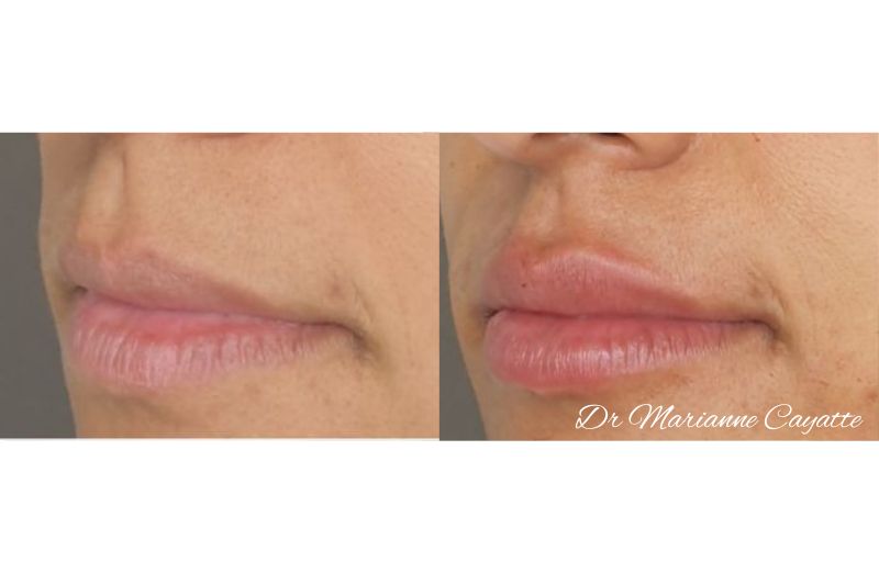 Souligner l'ourlet des lèvres · injection acide hyaluronique · Dr Marianne Cayatte Montpellier
