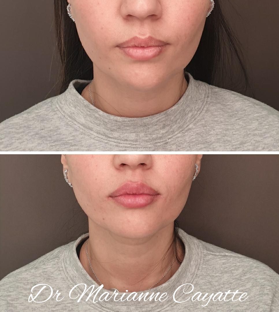 Injection acide hyaluronique lèvres volume et définition avant après · Dr Marianne Cayatte Montpellier
