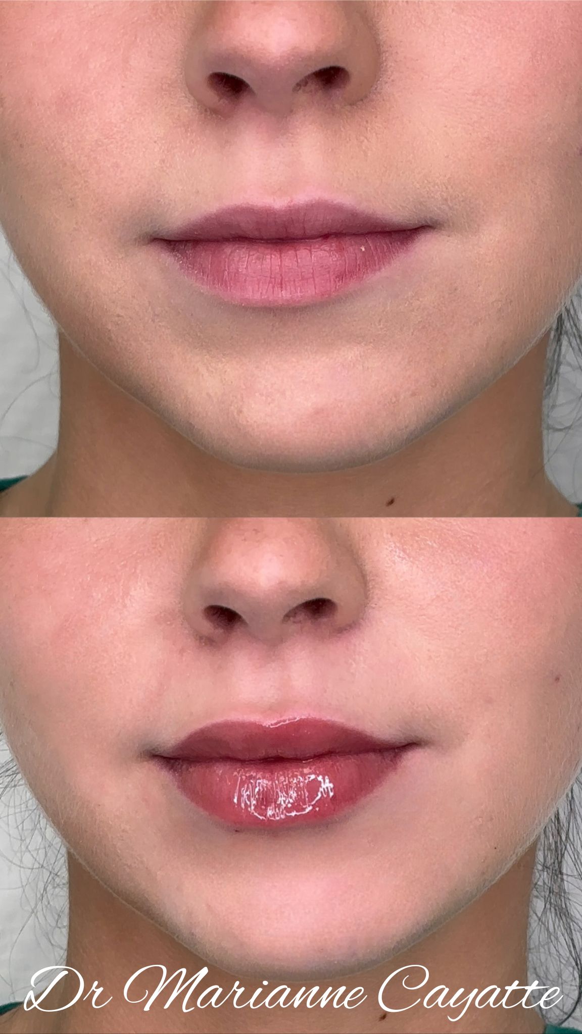 Injection acide hyaluronique lèvres arc de Cupidon avant après · Dr Marianne Cayatte Montpellier