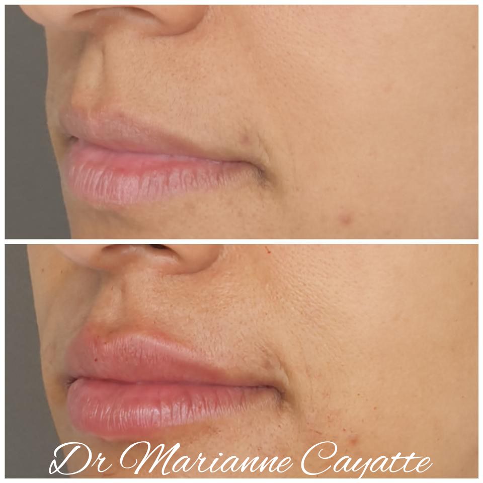 Injection acide hyaluronique lèvres correction ourlet avant après · Dr Marianne Cayatte Montpellier