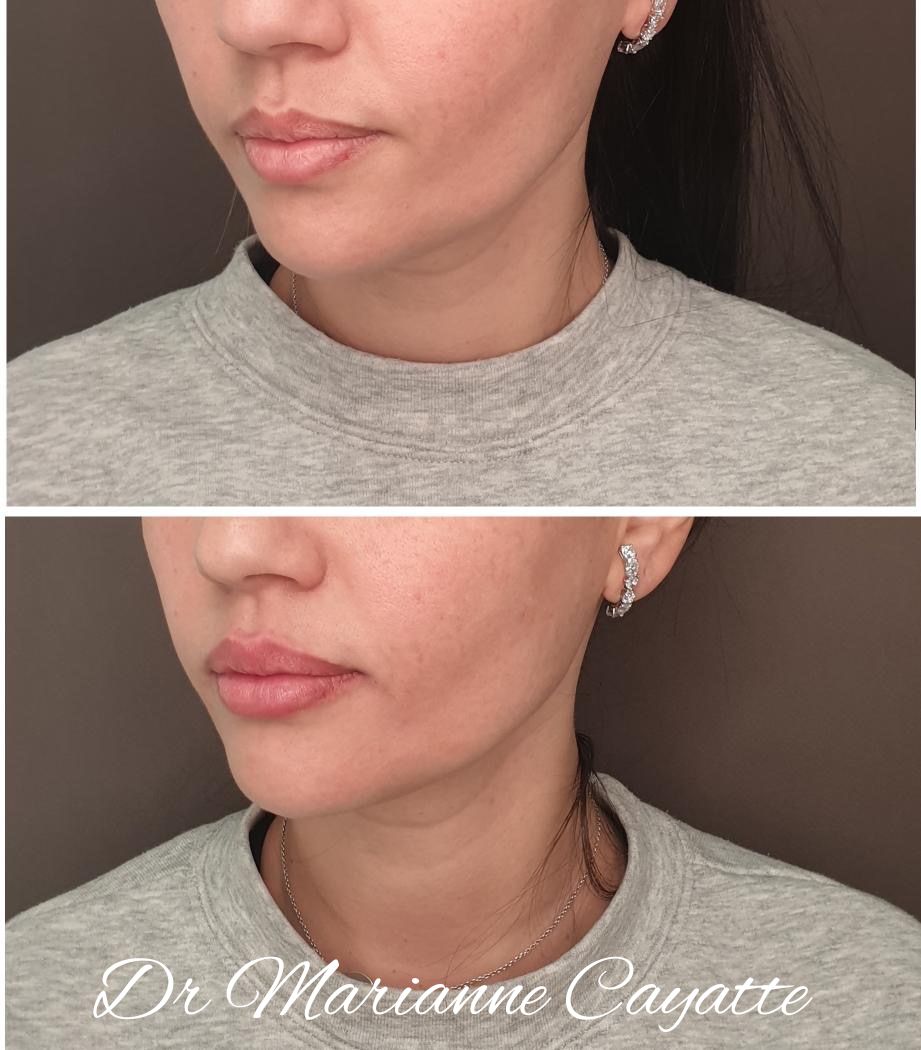 Injection lèvres acide hyaluronique Montpellier · Dr Marianne Cayatte