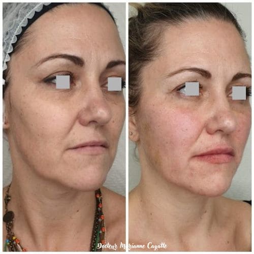MD Codes comblement acide hyaluronique visage résultat avant après · Dr Marianne Cayatte Montpellier