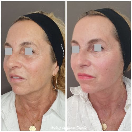 MD Codes traitement complet visage comblement acide hyaluronique avant après · Dr Marianne Cayatte Montpellier