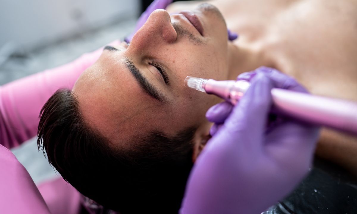 Microneedling peau masculine Montpellier · Dr Marianne Cayatte