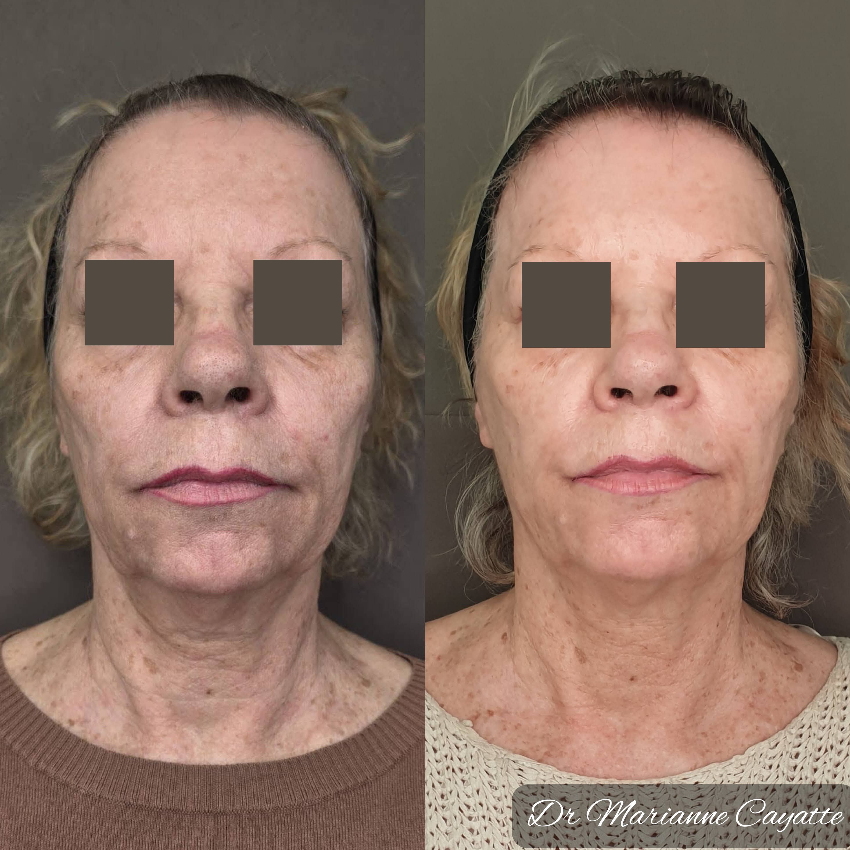 Ovale du visage restructuration acide hyaluronique avant après · Dr Marianne Cayatte Montpellier