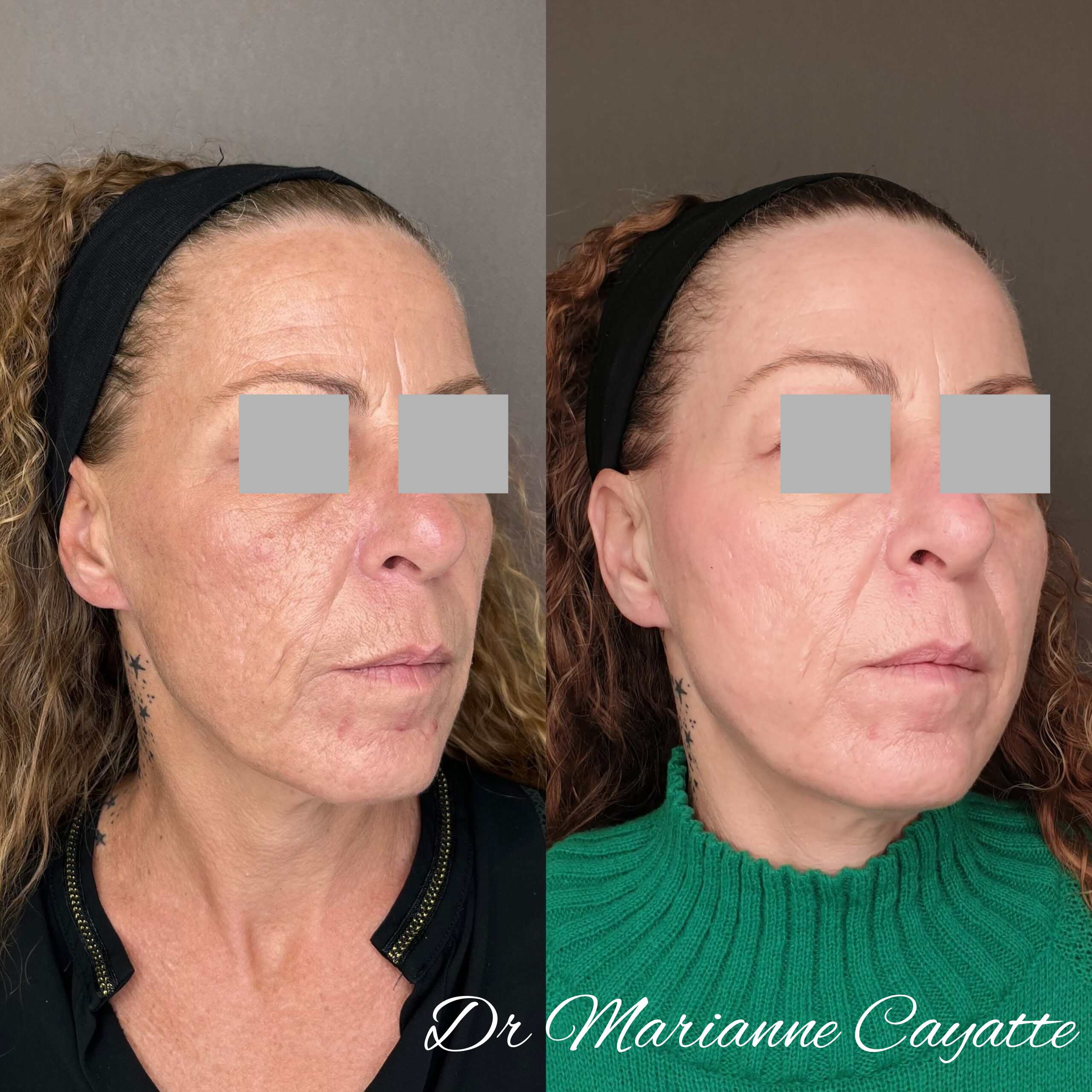 Cicatrices acné microneedling avant après · Dr Marianne Cayatte Montpellier