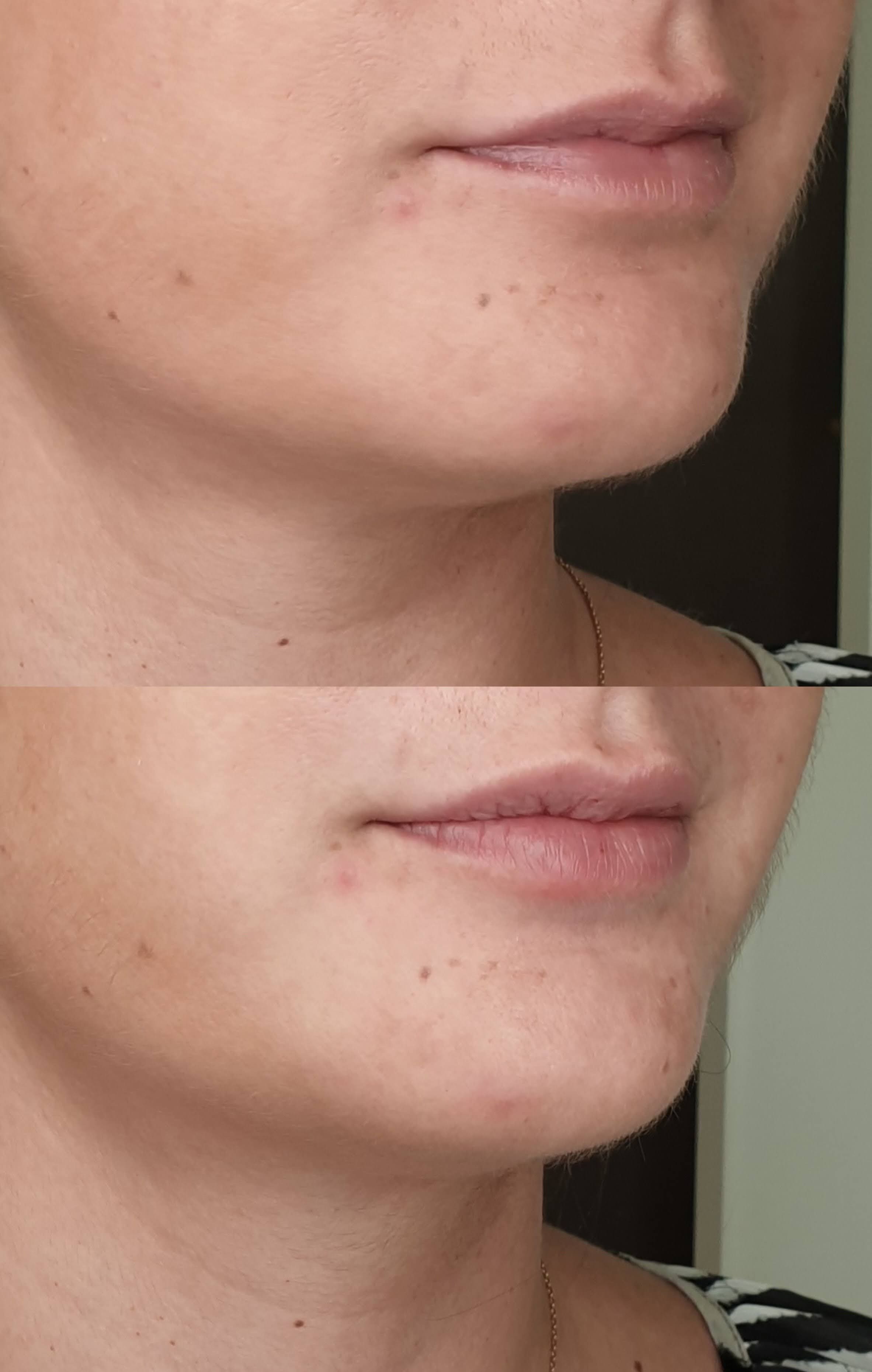 Lèvres injection acide hyaluronique volume naturel avant après · Dr Marianne Cayatte Montpellier