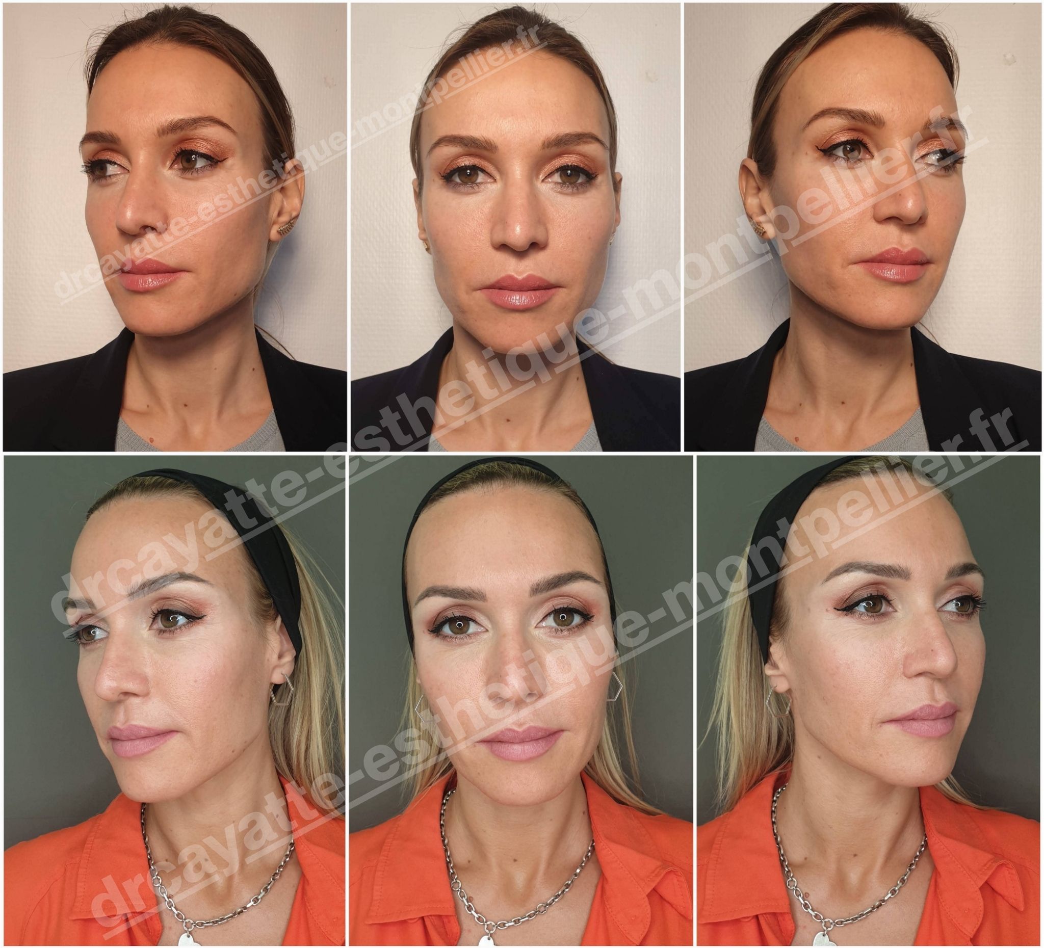 Injection acide hyaluronique femme résultat avant après · Dr Marianne Cayatte Montpellier