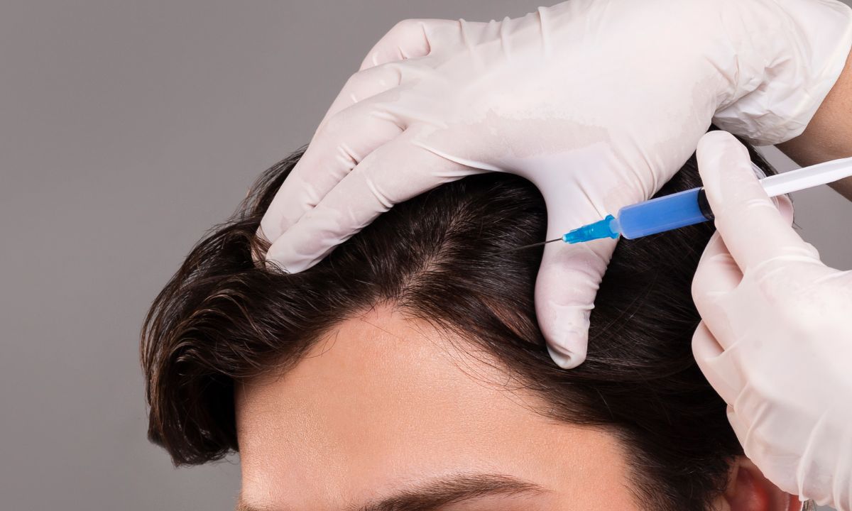 PRP capillaire micro-injection cuir chevelu · Dr Cayatte Montpellier