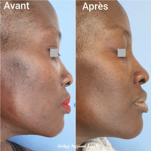 Taches acné peau pigmentée résultat avant après #2 · Dr Marianne Cayatte Montpellier